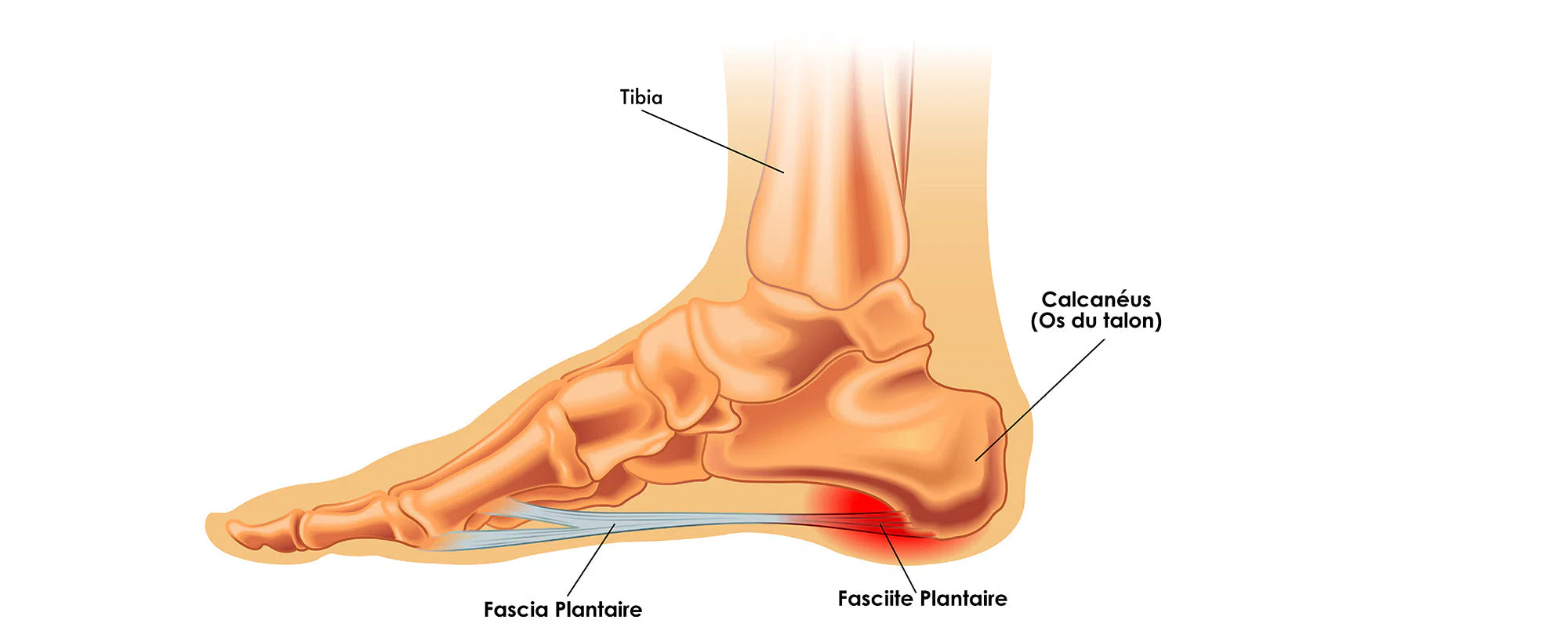 fasciite plantaire uccle